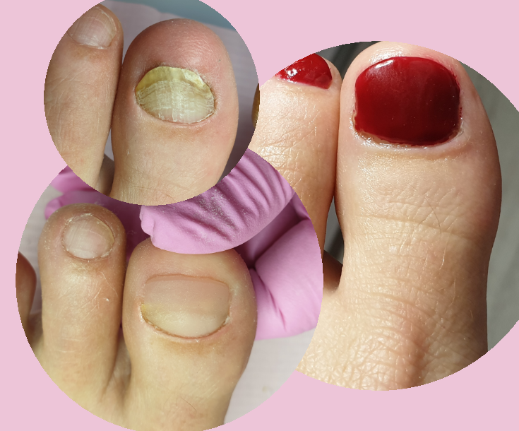 ondergeschikt moord Formulering Pedicure behandeling met correctie van 1 nagel en gellack